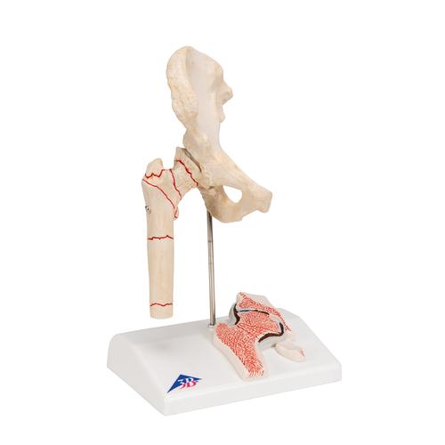 Fracture du fémur et usure de l'articulation de la hanche - 3B Smart Anatomy, 1000175 [A88], Modèles d'articulations