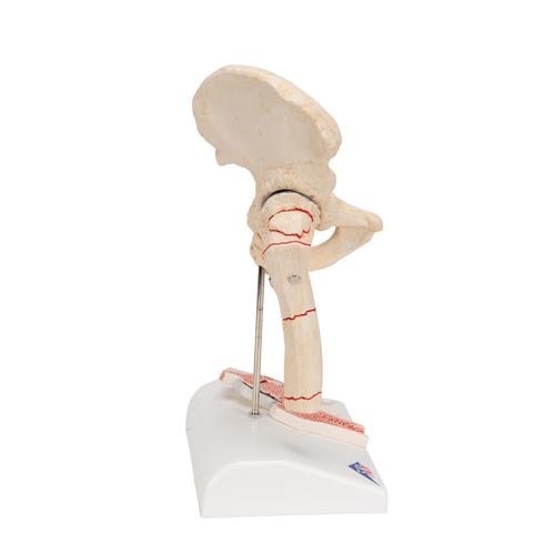 대퇴부 골절 및 고관절염 모형 Femoral Fracture and Hip Osteoarthritis - 3B Smart Anatomy, 1000175 [A88], 관절 모형