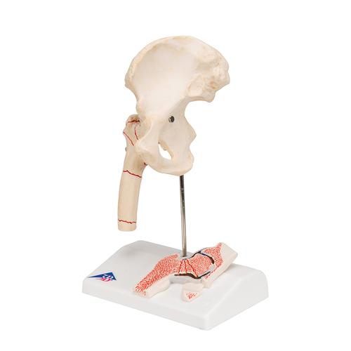 Fractura de fémur y desgaste de la articulación de la cadera - 3B Smart Anatomy, 1000175 [A88], Educación sobre artritis y osteoporosis