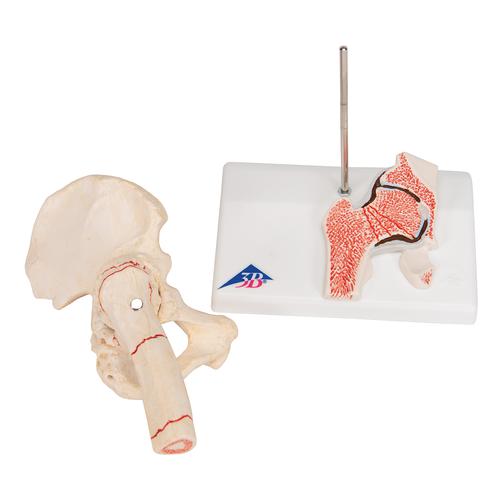 Human Femoral Fracture & Hip Osteoarthritis Model - 3B Smart Anatomy, 1000175 [A88], Joint Models