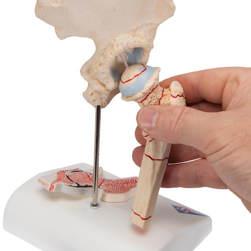 Модель перелома бедренной кости и остеоартрита тазобедренного сустава - 3B Smart Anatomy, 1000175 [A88], Модели суставов, кисти и стопы человека