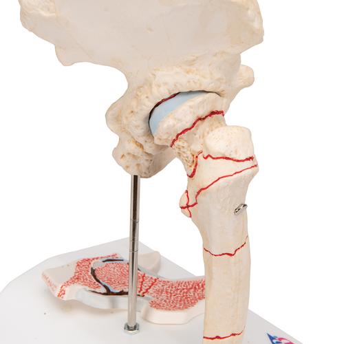 Fracture du fémur et usure de l'articulation de la hanche - 3B Smart Anatomy, 1000175 [A88], Modèles d'articulations