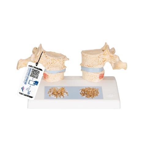 Modello di osteoporosi - 3B Smart Anatomy, 1000182 [A95], Modelli di Colonna Vertebrale