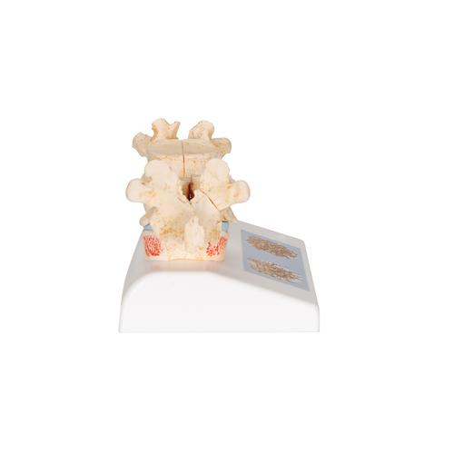 Osteoporosis Didactic Model - 3B Smart Anatomy, 1000182 [A95], Arthritis and Osteoporosis Education