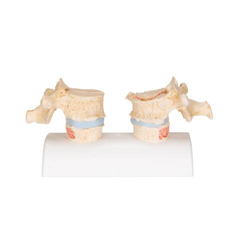 Модель остеопороза - 3B Smart Anatomy, 1000182 [A95], Модели позвоночника человека