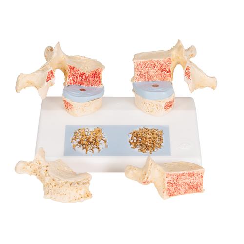 骨质疏松对比模型 - 3B Smart Anatomy, 1000182 [A95], 关节炎和骨质疏松症示意图