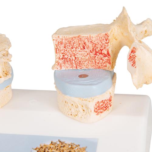 Modello di osteoporosi - 3B Smart Anatomy, 1000182 [A95], Modelli di vertebre