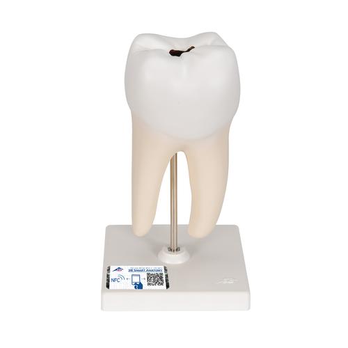 Dente molare inferiore a due radici, con carie, in 2 parti - 3B Smart Anatomy, 1000243 [D10/4], Modelli Dentali
