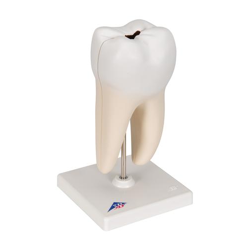 하악 대구치 충치 모형, 2파트 Lower Twin-Root Molar showing cavities, 2 part - 3B Smart Anatomy, 1000243 [D10/4], 교체 부품