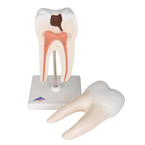 Dente molare inferiore a due radici, con carie, in 2 parti - 3B Smart Anatomy, 1000243 [D10/4], Modelli Dentali
