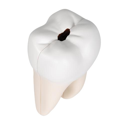 Molaire inférieure à deux racines, en 2 parties, avec carie - 3B Smart Anatomy, 1000243 [D10/4], Modèles dentaires