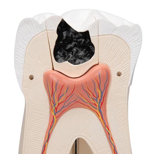 Гигантская модель моляра, пораженного кариесом, 15-кратное увеличение, 6 частей - 3B Smart Anatomy, 1013215 [D15], Модели зубов
