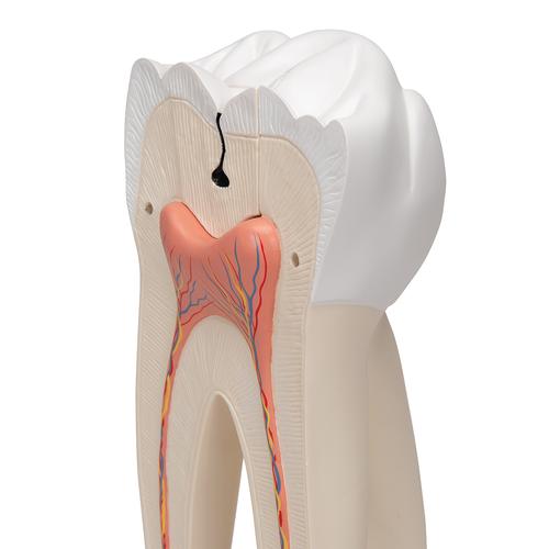 大臼齿，带龋，6部分 - 3B Smart Anatomy, 1013215 [D15], 牙齿模型