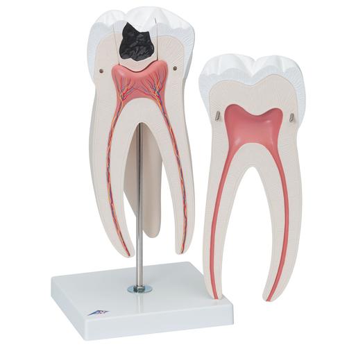 Giant Molar with Dental Cavities Human Tooth Model, 15 times Life-Size, 6 part - 3B Smart Anatomy, 1013215 [D15], Dental Models