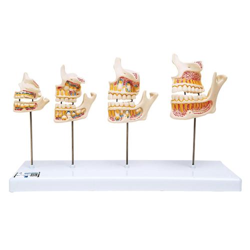 치아 성장 모형 Dentition Development - 3B Smart Anatomy, 1000248 [D20], 치아 모형
