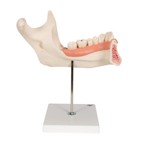 Metade inferior da mandíbula, 3 vezes o tamanho natural, 6 partes, 1000249 [D25], Modelos dentais