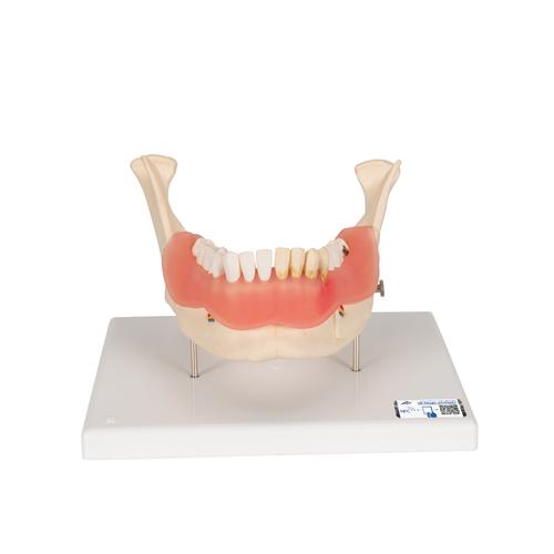 牙病模型，2倍放大，21个部分 - 3B Smart Anatomy, 1000016 [D26], 牙齿模型
