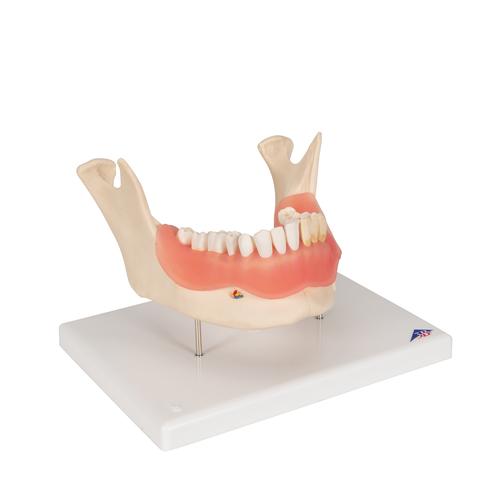 Diş Hastalıkları Modeli - 21 parça, 2 kat büyütülmüş - 3B Smart Anatomy, 1000016 [D26], Diş Modelleri