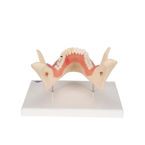 Afecci&oacute;n dental, a 2 aumentos, de 21 piezas, 1000016 [D26], Modelos dentales