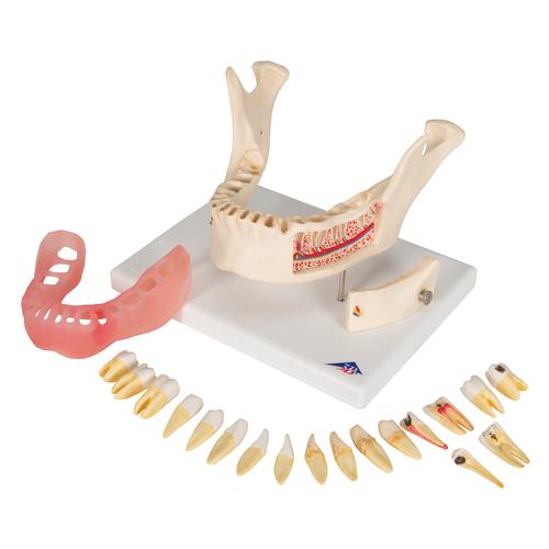 Doença dental, ampliado 2 vezes, em 21 partes, 1000016 [D26], Modelos dentais