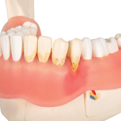 Dental Disease Model, Magnified 2 times, 21 parts - 3B Smart Anatomy, 1000016 [D26], Dental Models