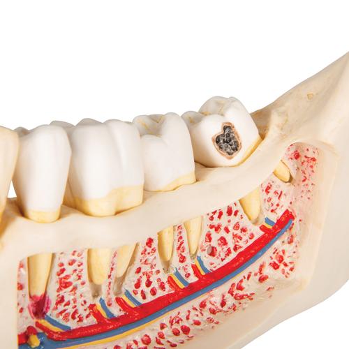 Afección dental, a 2 aumentos, de 21 piezas - 3B Smart Anatomy, 1000016 [D26], Modelos dentales