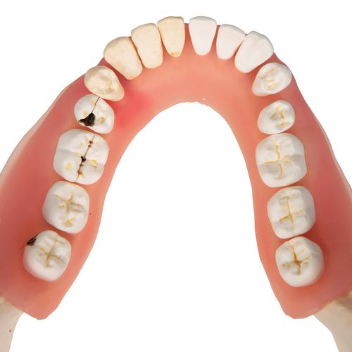 Afecci&oacute;n dental, a 2 aumentos, de 21 piezas, 1000016 [D26], Modelos dentales