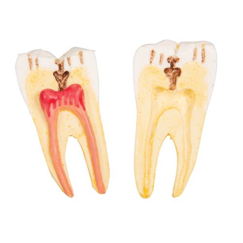 치아 질환 모형 Dental disease, magnified 2 times, 21 parts - 3B Smart Anatomy, 1000016 [D26], 치아 모형