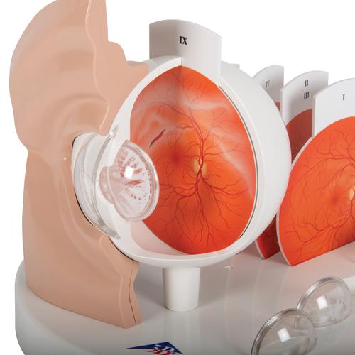 Occhio patologico, ingrandito 5 volte - 3B Smart Anatomy, 1017230 [F17], Modelli di Occhio