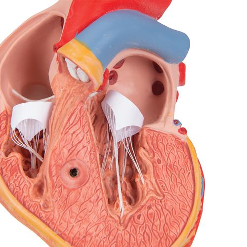 Cœur classique avec hypertrophie du ventricule gauche (HVG), en 2 parties - 3B Smart Anatomy, 1000261 [G04], Modèles cœur et circulation