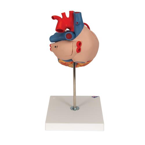 Coração com pontagem coronária, 2 vezes o tamanho natural, 4 partes, 1000263 [G06], Modelo de coração e circulação