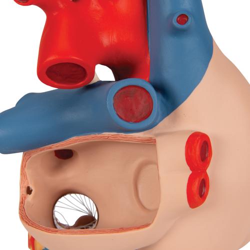 관상동맥 우회술 심장모형 실제크기2배 4-파트  Heart with Bypass, 2 times life size, 4 part - 3B Smart Anatomy, 1000263 [G06], 심장 및 순환기 모형