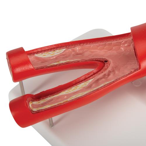 Arter çapraz kesitine sahip arterioskleroz model, 2 parçalı - 3B Smart Anatomy, 1000278 [G40], Kalp ve Dolaşım Modelleri