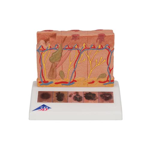 Hautkrebs Modell, 6 Stadien - 3B Smart Anatomy, 1000293 [J15], Hautmodelle