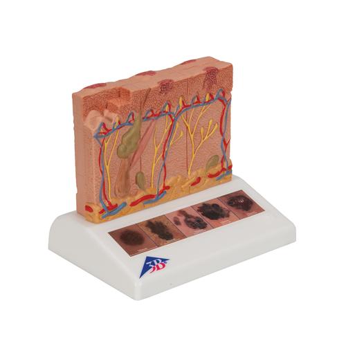 Modello di cancro delle pelle - 3B Smart Anatomy, 1000293 [J15], Modelli di Pelle
