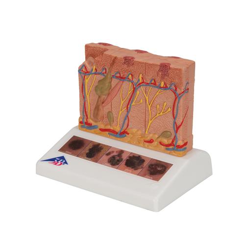 Skin Cancer Model with 5 stages, 8 times magnified - 3B Smart Anatomy, 1000293 [J15], Skin Models