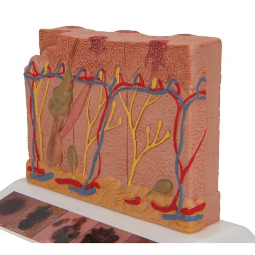 Modèle de cancer de la peau - 3B Smart Anatomy, 1000293 [J15], Modèles de dermes