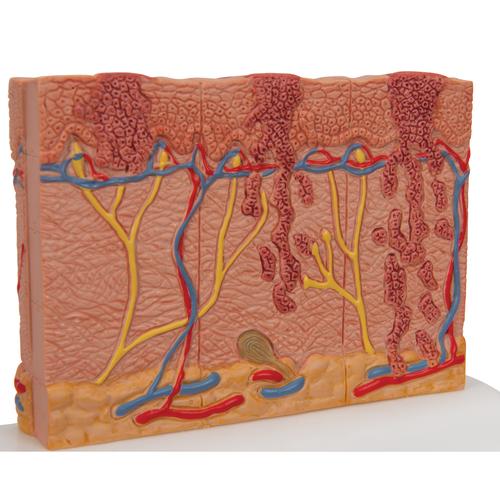 Skin Cancer Model with 5 stages, 8 times magnified - 3B Smart Anatomy, 1000293 [J15], Skin Models