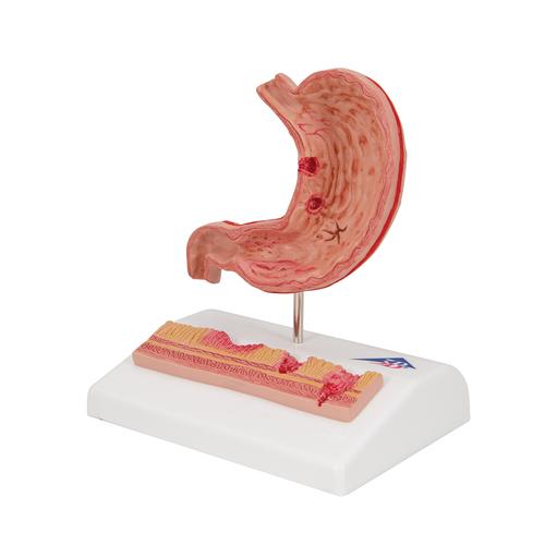 Модель желудка с язвами, 2 части - 3B Smart Anatomy, 1000304 [K17], Модели пищеварительной системы человека