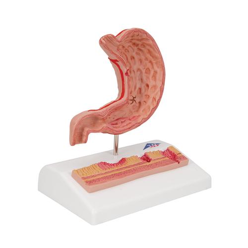 Estomac avec ulcères gastriques - 3B Smart Anatomy, 1000304 [K17], Modèles de systèmes digestifs