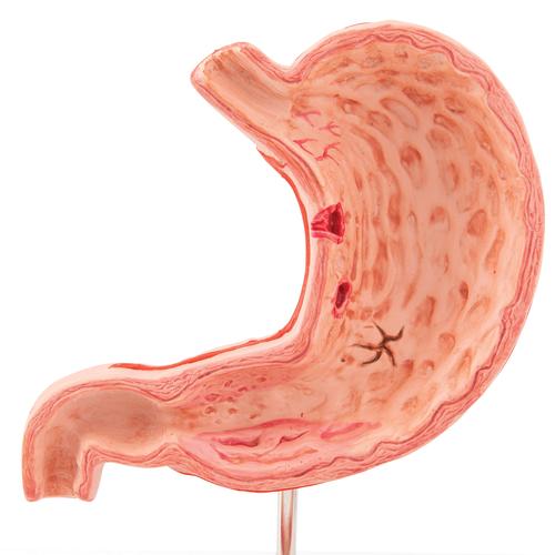 Estômago com úlceras gástricas, 1000304 [K17], Modelo de sistema digestivo