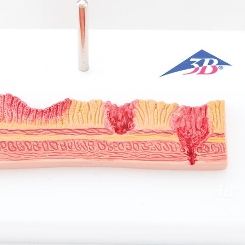 胃溃疡模型 - 3B Smart Anatomy, 1000304 [K17], 消化系统