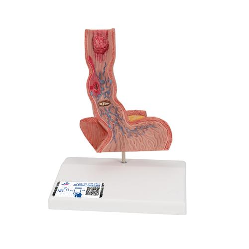 食管疾病模型 - 3B Smart Anatomy, 1000305 [K18], 消化系统