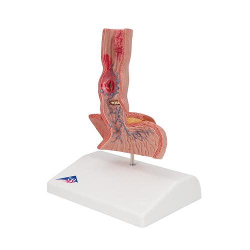Yemek Borusu Hastalıkları - 3B Smart Anatomy, 1000305 [K18], Sindirim Sistemi Modelleri