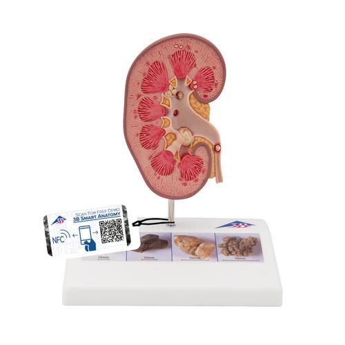 Kidney Stone Model - 3B Smart Anatomy, 1000316 [K29], Urology Models