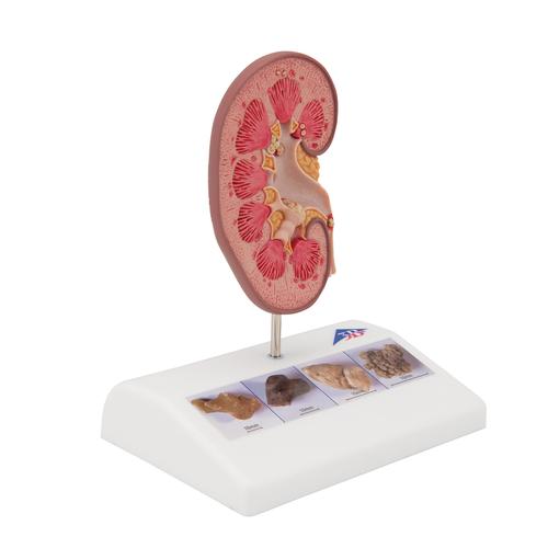Modelo de c&aacute;lculo renal, 1000316 [K29], Modelos del Sistema Urinario
