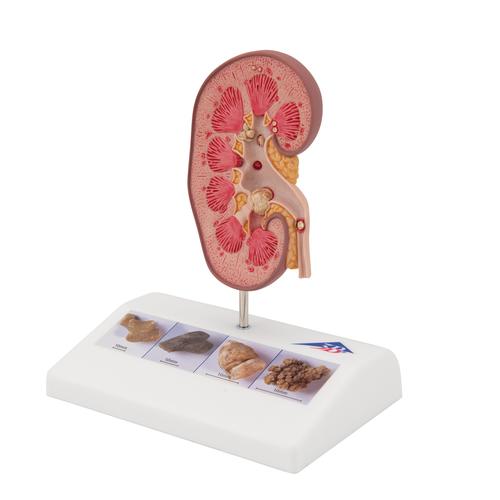 Kidney Stone Model - 3B Smart Anatomy, 1000316 [K29], Urology Models