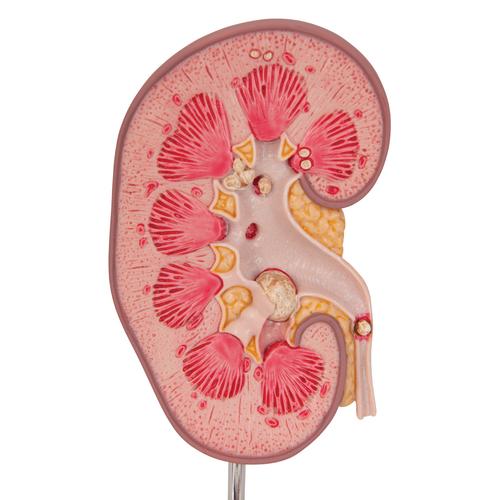 신장결석 모형
Kidney Stone Model - 3B Smart Anatomy, 1000316 [K29], 비뇨기계 모형