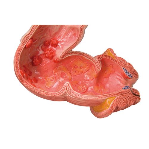 Pathologisches Darmmodell (Dick- und Enddarm) - 3B Smart Anatomy, 1008496 [K55], Verdauungssystem
