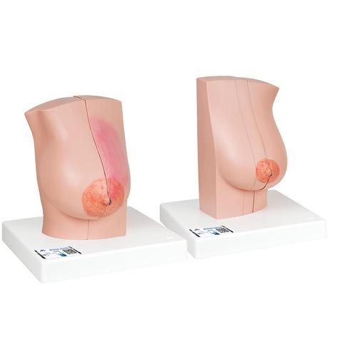 Model of Female Breast with Healthy & Unhealthy Tissue - 3B Smart Anatomy, 1008497 [L56], Breast Models